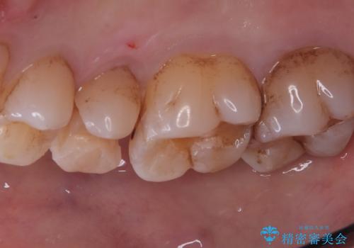 【セラミックインレー】海外に行く前に虫歯治療してほしいの治療中