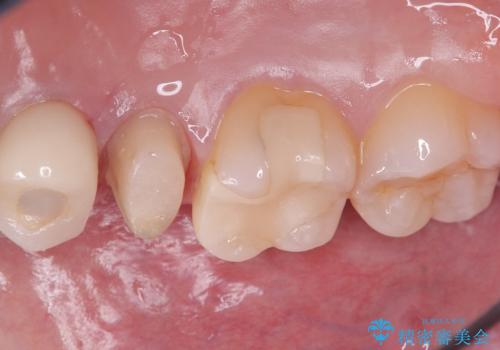 【セラミッククラウン】銀の詰め物していた歯が割れたの治療中