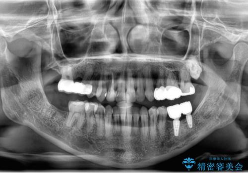 あきらめないで!!虫歯でボロボロでも大丈夫!　非抜歯矯正と虫歯、インプラント治療で見違える歯並びに。の治療後