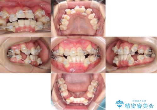 【ワイヤー矯正】八重歯　歯のでこぼこを治したい!の治療中