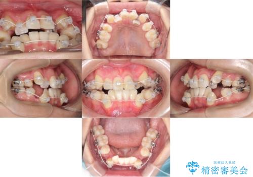 【ワイヤー矯正】八重歯 歯のでこぼこを治したい!の治療中