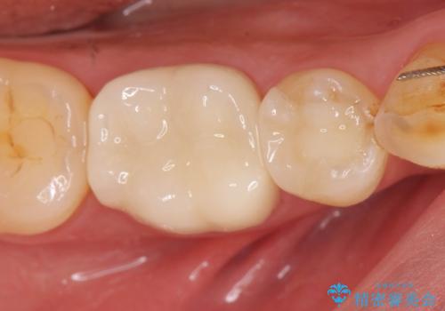 治療途中の歯 セラミック治療を希望され来院の症例 治療後