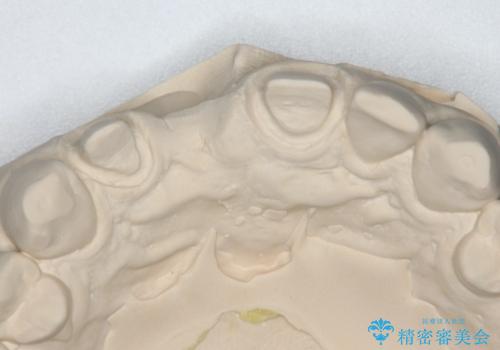 前歯ブリッジのやり変え希望 オールセラミッククラウンの治療中