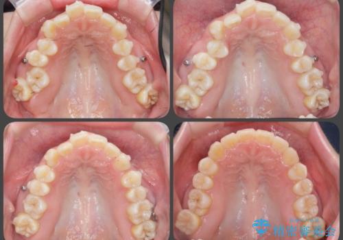 サクソフォン(アルト)の演奏で崩れてしまった歯並び、マウスピース矯正治療