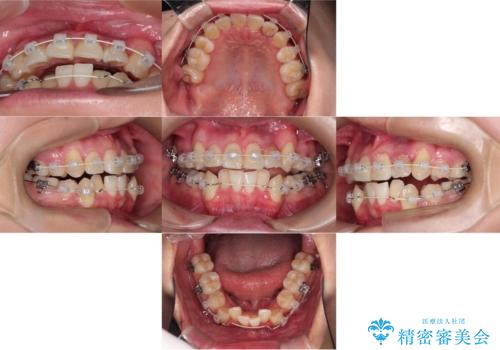 【ワイヤー矯正】八重歯　歯のでこぼこを治したい!の治療前