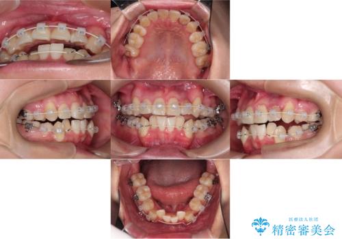 【ワイヤー矯正】八重歯 歯のでこぼこを治したい!の治療前