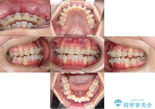 【ワイヤー矯正】八重歯　歯のでこぼこを治したい!の治療中