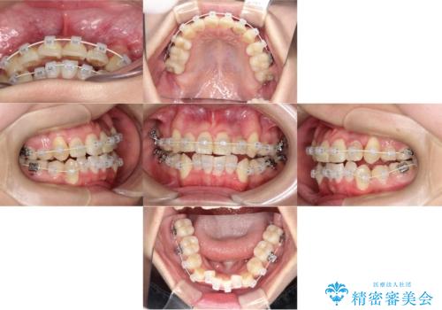 【ワイヤー矯正】八重歯 歯のでこぼこを治したい!の治療中