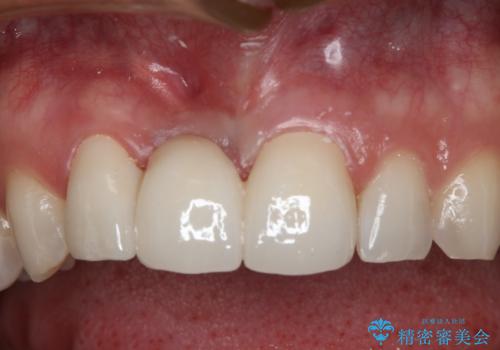 前歯ブリッジのやり変え希望 オールセラミッククラウンの治療後