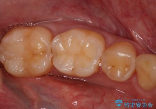 奥歯の保険材料を自費でやり直したいの症例 治療前
