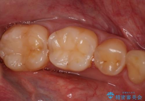奥歯の保険材料を自費でやり直したいの治療前