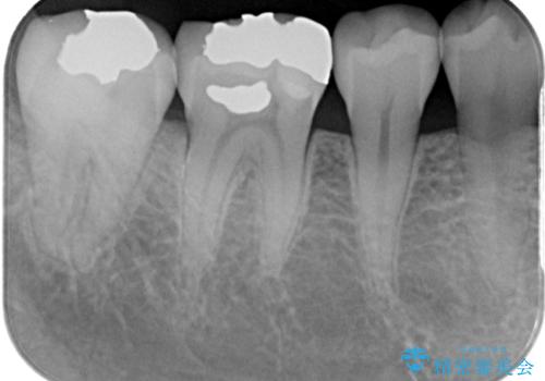 銀歯をやり替えたい　フルジルコニアクラウン・セラミックインレー修復の治療前