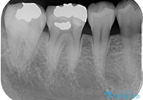 銀歯をやり替えたい フルジルコニアクラウン・セラミックインレー修復の治療前