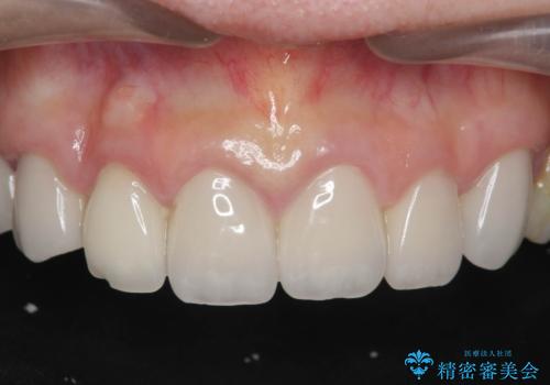 [ 歯ぐきから出血をする ]　歯周外科を伴うセラミックやりかえ治療の治療前