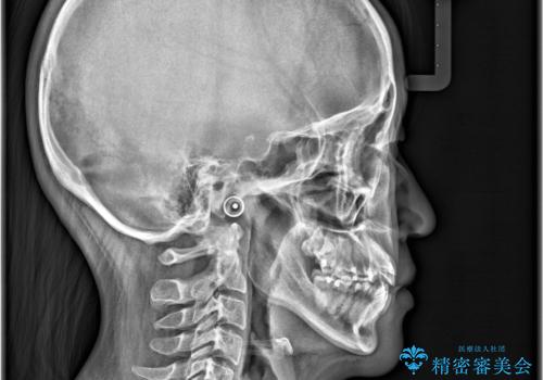 【ワイヤー矯正】八重歯 歯のでこぼこを治したい!の治療前