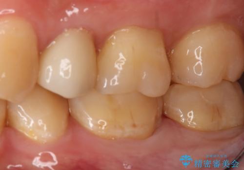 奥歯の保険材料を自費でやり直したいの治療後