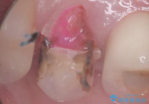 【セラミッククラウン】銀の詰め物していた歯が割れたの治療前