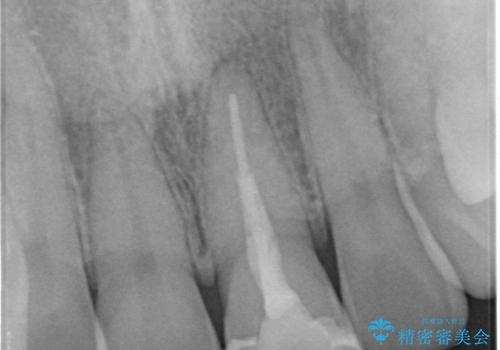 前歯の変色とガタつき ジルコニアクラウンでの修復の治療前