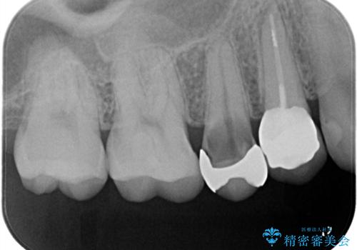 【セラミッククラウン】銀の詰め物していた歯が割れたの治療前