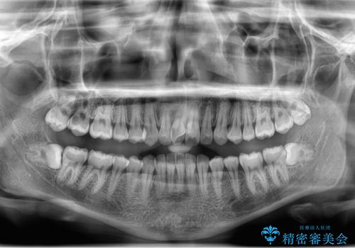 左の親知らず抜歯したい。の治療前