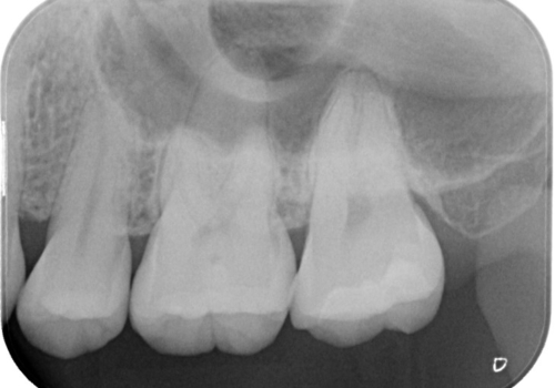 虫歯の再発　セラミックインレーにて治療の治療後