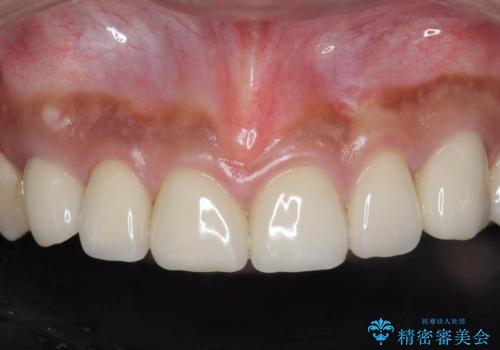 複数箇所コンポジット充填された前歯をセラミック治療の症例 治療後