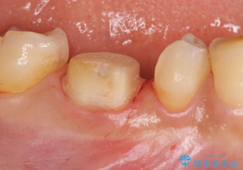 治療途中の歯 セラミック治療を希望され来院の治療中