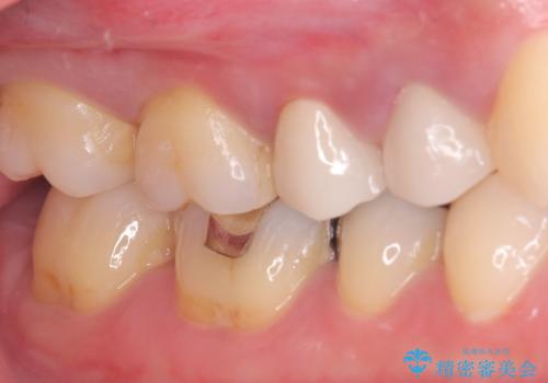 【セラミッククラウン】銀の詰め物していた歯が割れたの治療後