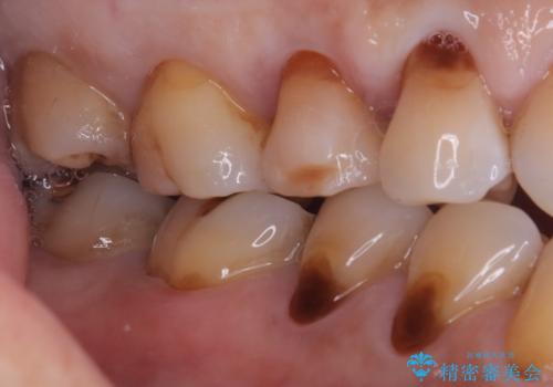【セラミックインレー】海外に行く前に虫歯治療してほしいの治療後