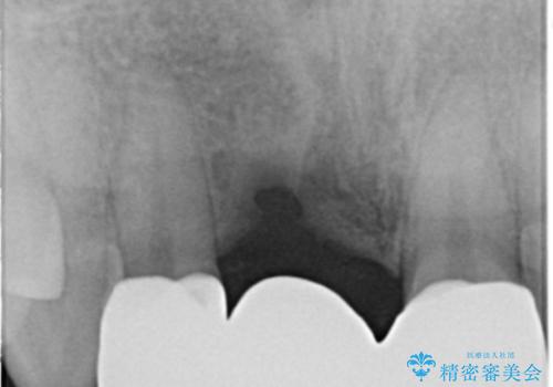 前歯ブリッジのやり変え希望 オールセラミッククラウンの治療後