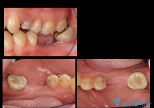 奥歯のインプラントの症例 治療前