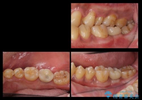 奥歯のインプラントの治療後