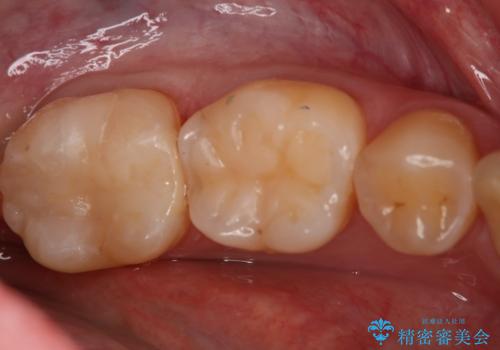 奥歯の保険材料を自費でやり直したいの症例 治療後