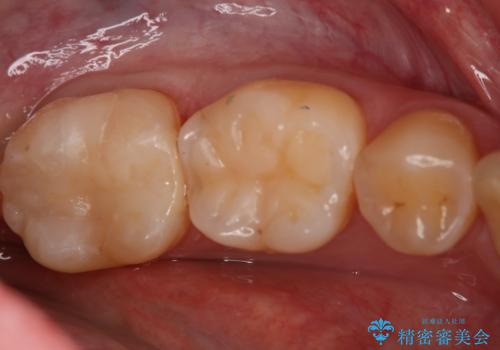 奥歯の保険材料を自費でやり直したい