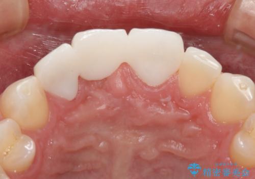 前歯ブリッジのやり変え希望 オールセラミッククラウンの治療後