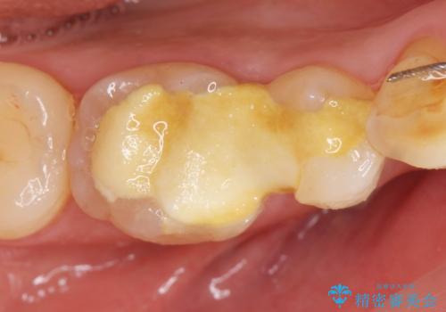 治療途中の歯 セラミック治療を希望され来院の症例 治療前