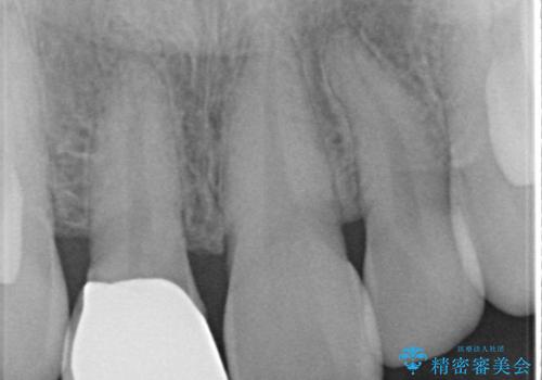 前歯の色・形が気になる オールセラミッククラウンで綺麗に (アライナー矯正併用)の治療前