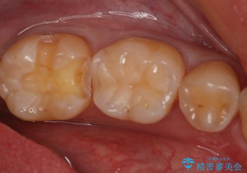 奥歯の保険材料を自費でやり直したいの治療中