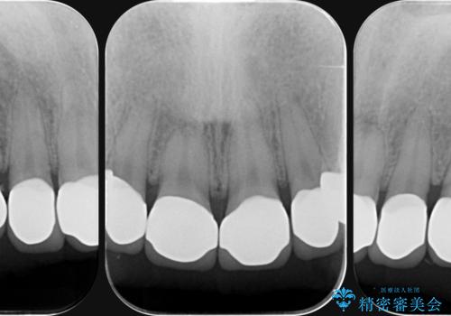 複数箇所コンポジット充填された前歯をセラミック治療の治療後