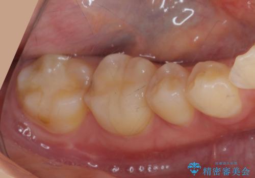 虫歯をセラミックで治療