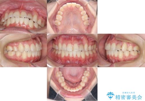 【ワイヤー矯正】八重歯　歯のでこぼこを治したい!の治療後