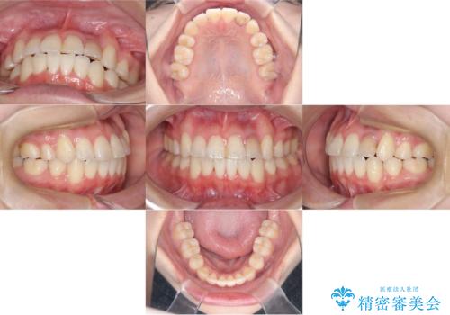 【ワイヤー矯正】八重歯 歯のでこぼこを治したい!の治療後