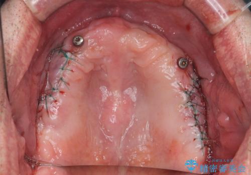 全体的に治したい。インプラントオーバーデンチャーによる治療。の治療後