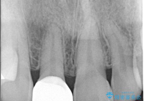 前歯の色・形が気になる オールセラミッククラウンで綺麗に (アライナー矯正併用)の治療後