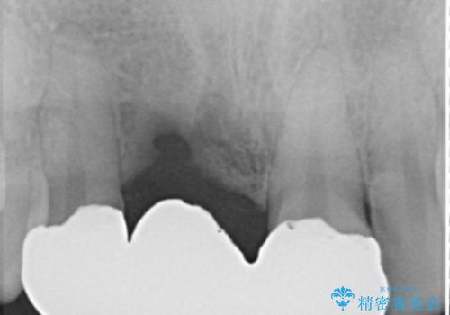 前歯ブリッジのやり変え希望 オールセラミッククラウンの治療前