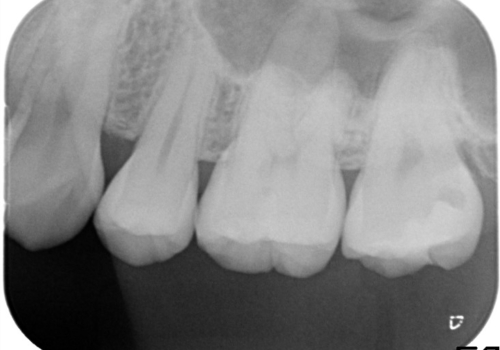 虫歯の再発　セラミックインレーにて治療の治療前