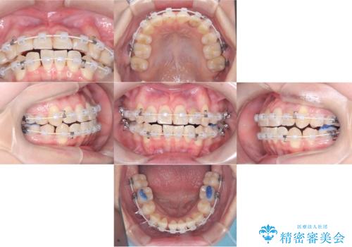【ワイヤー矯正】八重歯　歯のでこぼこを治したい!の治療後