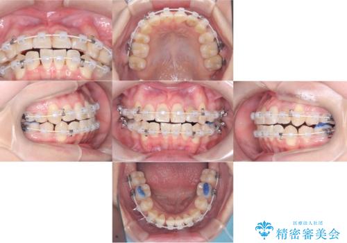 【ワイヤー矯正】八重歯 歯のでこぼこを治したい!の治療後