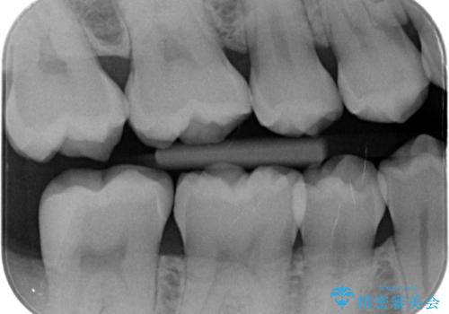 斜めに生えてきている親知らずを抜きたいの治療後