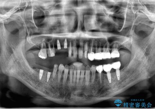 虫歯・噛み合わせ・インプラント、全顎総合治療の治療中